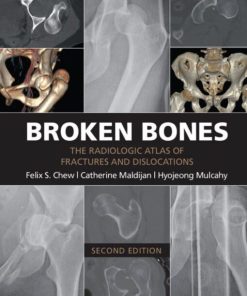 Broken Bones The Radiologic Atlas of Fractures and Dislocations 2nd 2E
