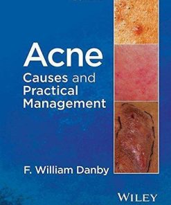 Acne Causes And Practical Management
