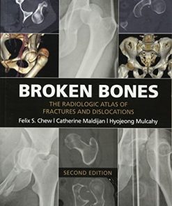Broken Bones The Radiologic Atlas of Fractures and Dislocations